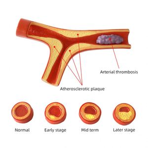 Modelo de Aterosclerosis y Trombosis Humana KyrenMed, Modelo Cardiovascular de Aterosclerosis Ampliado 10 Veces - Product Image 2
