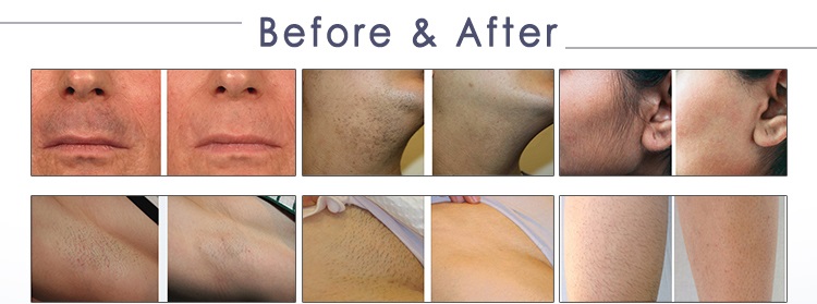 Triple Wave 755 808 1064nm Laser sopran Titanium Diode Lazer Laser Hair Removal