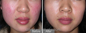 Laser bedah gigi perawatan varises, kanula 1470nm 980nm untuk mesin Pengencang kulit velashape kelas medis lipolaser