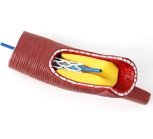 Modelo de <span class=keywords><strong>Stent</strong></span> Vascular Humano KyrenMed, Modelo de Arteria Coronaria, Obstrucción de Vasos Sanguíneos Cardiovasculares, Modelo de Soporte para Bloqueo de Vasos Sanguíneos - Product Image 3