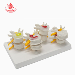 El modelo de columna vertebral humana FRT032 utiliza una vértebra lumbar normal y un modelo de lesión de hernia de disco intervertebral lumbar de 4 etapas. - Product Image 3