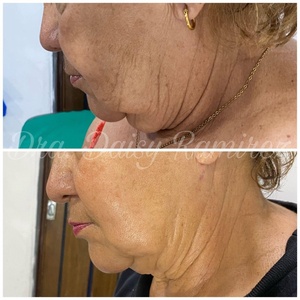 1470nm Laser fibre quang endolaser lipolysis mặt nâng endo máy laser - Product Image 5