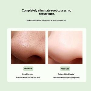 Waterproof ABS Blackhead Suction Device Vacuum Facial <b>Pore</b> <b>Cleaner</b> Acne Removal Handheld Beauty Tool - Product Image 5