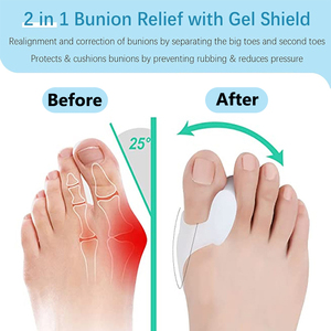 Kể từ khi chỉnh hình chồng chéo ngón chân lớn bunion Corrector Toe miếng đệm spreader Gel Toe separators - Product Image 2