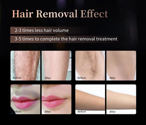 Machine d'épilation à diode haute puissance 4000W, modèle stationnaire sur pied, 755 808 1064nm, 4D Teclaser Smart Diode Lase - <span class=keywords><strong>Prix</strong></span> - Product Image 6