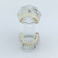 Implant dentaire détachable pathologique avec nerfs dent résine PVC pont couronne modèle de démonstration modèle de Construction