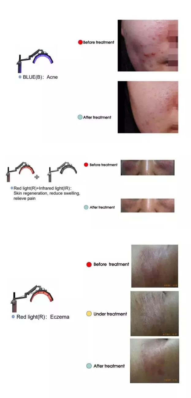Vertical Korea PDT Facial Treatment LED Red Light therapy + Blue Light + Infrared 3 in 1 LED PDT skin whitening machine