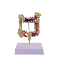 Modelo patológico de intestino grueso, lesiones gastrointestinales, modelo anatómico, enfermedad intestinal, modelo de lesiones de colon humano