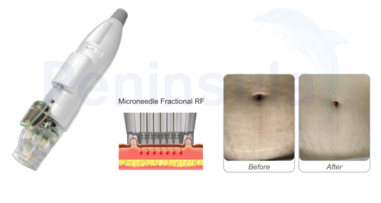 Peninsula Fractional RF Micro Needle Skin Care System 240V 3