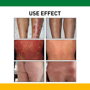 Meilleures ventes de <span class=keywords><strong>crème</strong></span> de soin à base de plantes pour réparer les ampoules anti-démangeaisons des mains et des pieds - Product Image 3