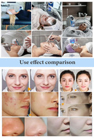 Appareil de beauté pour le visage à oxygène hyperbare, jet d'eau oxygénée, rajeunissement de la peau, anti-âge, blanchiment