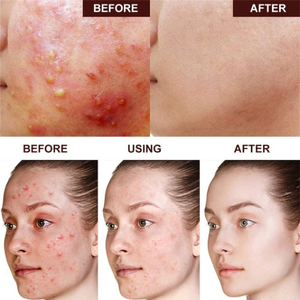 Crème Visage Anti-Acné de Marque Privée à la Niacinamide, Gel Réparateur Anti-Âge, Crème Apaisante pour l'Élimination des Cicatrices d'Acné OEM - Product Image 3