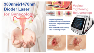 Láser Ginecológico de Grado Médico de 980 nm, Láser de Rejuvenecimiento Vaginal de 1470 nm, Terapia Láser Ginecológica Mínimamente Invasiva - Product Image 3