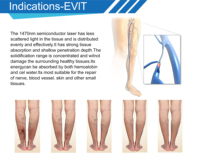 Coagulation laser endoveineuse EVLT EVLA Phlebologie Varices Laser endoveineux 1470nm