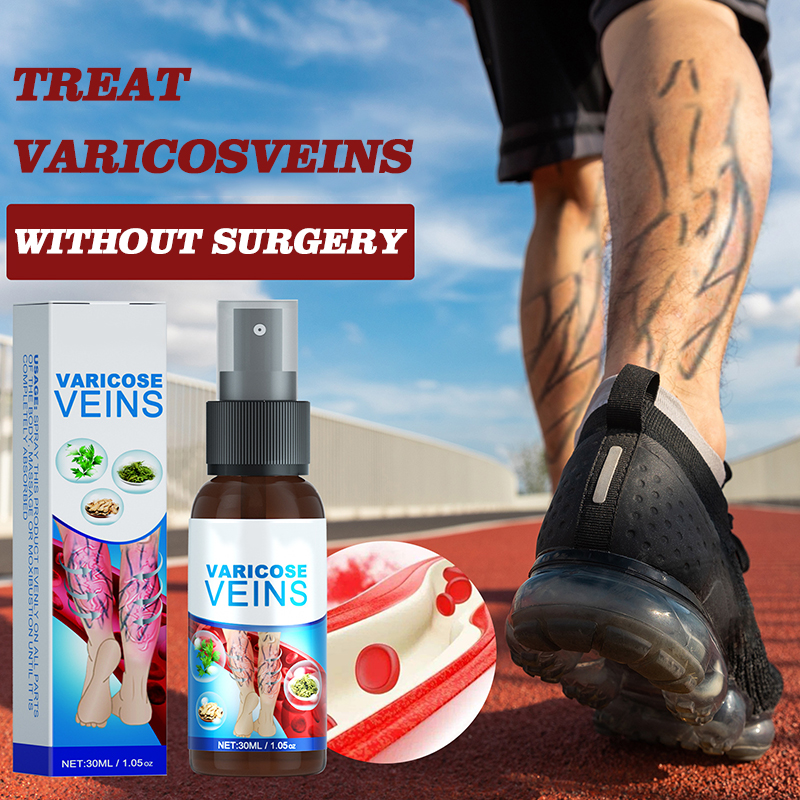 hot sell varicose veins remover treatment spray for veins earthworm leg torment 30ml
