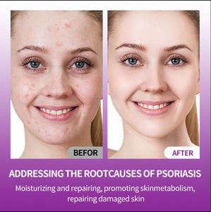 Crème antibactérienne d'essences d'extraits de plantes de médecine chinoise naturelle de haute qualité réduit la qualité de la réponse <span class=keywords><strong>inflammatoire</strong></span> de la peau - Product Image 6