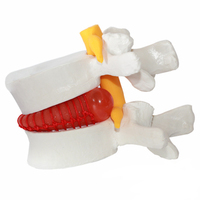 Modelo de demostración de enseñanza asistida, modelo de hernia de disco lumbar, modelo de disco intervertebral