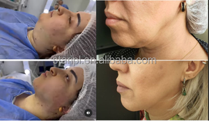 Alat penyedot lemak, pengangkat kulit dagu ganda, Diode 980nm 1470nm, serat lipololisis, perawatan Non invasif - Product Image 6