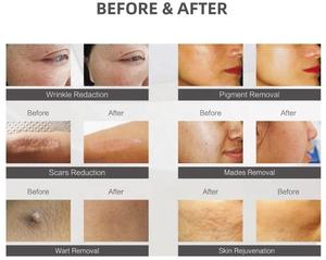 Tube <span class=keywords><strong>laser</strong></span> <span class=keywords><strong>CO2</strong></span> multifonctionnel, machine de raffermissement vaginal au <span class=keywords><strong>laser</strong></span> <span class=keywords><strong>CO2</strong></span>, équipement de beauté - Product Image 6