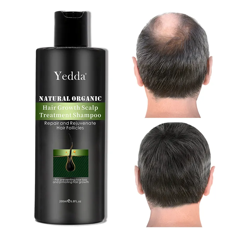 Champú para la pérdida de cabello, champú profesional para el crecimiento del cabello, calvicie