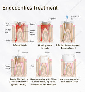 Microblaster di ossido di alluminio per la pulizia dei denti apparecchiature dentali microblaster dentale - Product Image 6