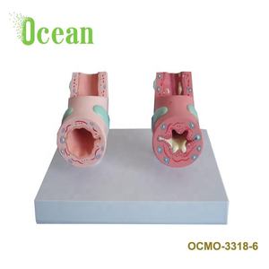 Modè<span class=keywords><strong>le</strong></span> de bronchies asthmatiques normales, modè<span class=keywords><strong>le</strong></span> médical de pathologie trachéale pour la publicité, l'éducation <span class=keywords><strong>et</strong></span> la démonstration - Product Image 2