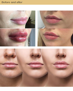 Pluma Eléctrica de Ácido para la Piel 2026, Nuevo Modelo, Rejuvenecimiento y Estiramiento de la Piel, Recargable - Product Image 6