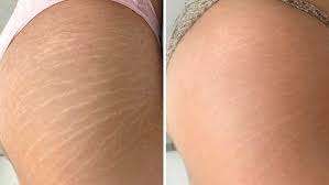 Dispositivo de Belleza con Masaje al Vacío para Fortalecer y Tonificar los Músculos Abdominales, Eliminar Espasmos, Drenaje Linfático y Pérdida de Peso - Product Image 6