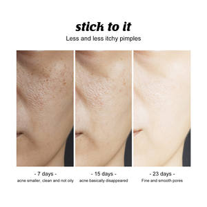 Savon Solide Nettoyant Visage Fait Main de Haute Qualité 120g, Bestseller, Anti-Acné, Contrôle du Sébum, Blanchissant, pour le Bain et le Corps - Product Image 3