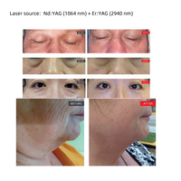 Equipo de Belleza Láser de Pulso Largo Nd Yag 1064nm de Japón, Láser de Erbio y CO2 para Lifting Facial y Tratamiento de Cicatrices de Acné