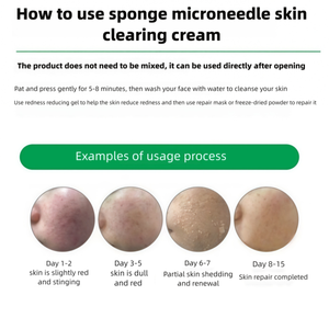 Kit de Eliminación de Manchas Oscuras y Melasma, Esponja Bio con Microagujas de Algas, <span class=keywords><strong>Gel</strong></span> Exfoliante para Manchas Negras y <span class=keywords><strong>Gel</strong></span> Calmante y Refrescante para la Piel - Product Image 2