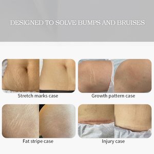 <span class=keywords><strong>Crema</strong></span> per Smagliature a Marchio Privato per Cicatrici e Segni dell'Acne, Trattamento Professionale per Cicatrici OEM/ODM - Product Image 4