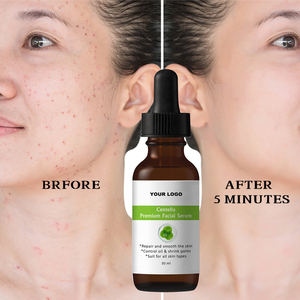 Siero Viso Centella Anti-Allergia di Alta Qualità, Effetto in 5 Minuti, Schiarente e Nutriente, Elimina le Vene Rosse - Product Image 1