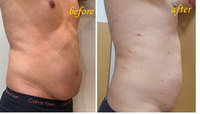 Appareil de chirurgie esthétique pour l'élimination de la graisse par liposuccion Vaser 980 nm, lipolyse endolaser 1470 nm, lifting