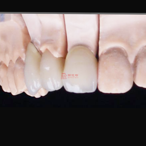 Tecnologia di stampa Laser 3D per cliniche dentali personalizzate corone e ponti in Cina laboratorio dentale - Product Image 5