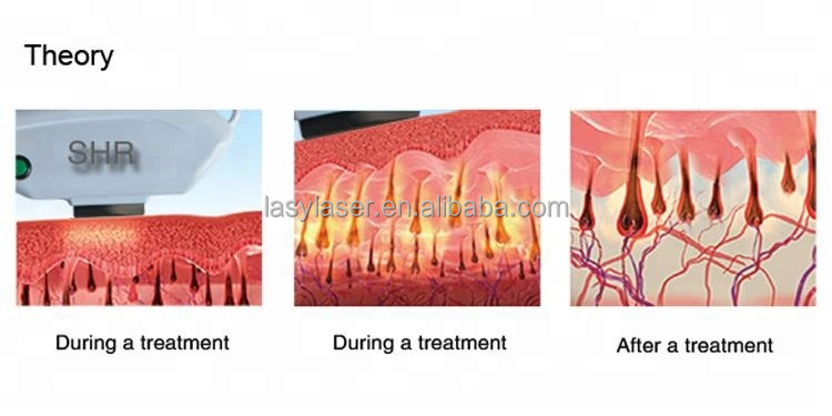 máquina ipl Alemanha da remoção do cabelo do shr para o equipamento rápido do rejuvenescimento da pele da remoção do cabelo com exposição nova de DWIN