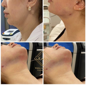 Fibra óptica Endo Laser Estiramiento facial Estiramiento DE LA PIEL <span class=keywords><strong>Lipólisis</strong></span> facial 980nm 1470nm Fiberlift Endolaser Machine - Product Image 6