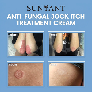 Crema Profesional para <span class=keywords><strong>la</strong></span> Picazón <span class=keywords><strong>en</strong></span> el Huesco del Empeine |   Tratamiento de acción rápida para <span class=keywords><strong>la</strong></span> <span class=keywords><strong>tiña</strong></span> y el pie de atleta |   Alivio Calmante de 100 ml para Piel Irritada y con Picazón - Product Image 6