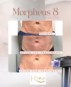 Martillo Frío Profesional de 3 Puntas Doradas con Micro-puntas para Rejuvenecimiento Facial, Antienvejecimiento, Antiarrugas y Eliminación de Acné, para Reafirmar la Piel del Rostro - Product Image 4