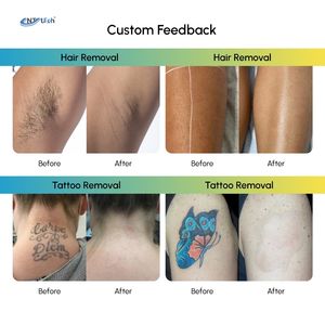 Beijing Unttech XPLUS9 2-in-1 Dioden-NdYAG-Laser Haarentfernungs- und Tätowierungsgerät 755nm/1064nm Wellenlängen Gewerbliche Nutzung 2 Jahre - Product Image 5