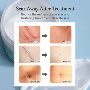 Crema Blanca para Eliminar Cicatrices de Embarazo, Estrías y Acné, Ingredientes Herbales 100% Naturales, Antiarrugas, 50g - Product Image 2