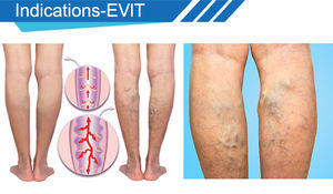 Máquina Portátil Eficaz para el Tratamiento de Várices en las Piernas EVLT EVLA 980nm 1470nm 3000ms, Cuidado Facial, Eliminación de Arañas Vasculares - Product Image 4