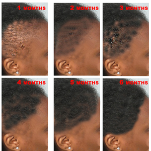 Private Label Ginger Natural Organic Hyaluronic Acid Nourishing Fluffy Anti Loss Regrowth Biotin Fast Hair Growth Oil Serum - Product Image 3