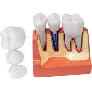Modèle d'implant dentaire oral avec couronne et pont amovibles, adapté à la démonstration et à la formation des étudiants en dentisterie - Product Image 1