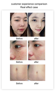 <span class=keywords><strong>Appareil</strong></span> professionnel Scarlet pour le blanchiment et la régénération de la peau, la gestion des rides et des ridules, machine faciale - Product Image 6