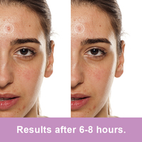 Patch Hydrocolloïde Anti-Acné à Couleur Changeante, Traitement Invisible et Fin pour les Boutons, Soin de la Peau du Visage, Logo Personnalisé OEM