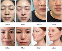 Promotion : Appareil de lifting facial EM/EMRF pour l'élimination du double menton et le raffermissement du visage, du front et des yeux