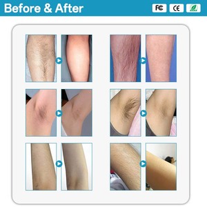 สเปรย์กำจัดขนจากโรงงาน เครื่องเลเซอร์อเล็กซานไดรต์ เครื่องกำจัดขนด้วยเลเซอร์ <span class=keywords><strong>wahl</strong></span> เครื่องกำจัดขนด้วยแว็กซ์แบบมืออาชีพ เลเซอร์ไดโอด - Product Image 3