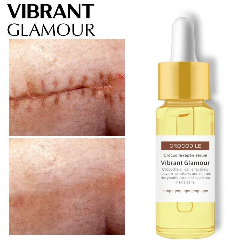 VIBRANT GLAMOURクロコダイル修理傷跡美容液除去ニキビ傷跡ホワイトニングスポットニキビ治療ストレッチマークスキンケア