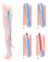 EVLT EVLA Radical Fiber Tête ronde avec échelle pour usage chirurgical